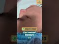 Cyst removal surgery in Delhi | Cyst Removal Procedure | SkinQure