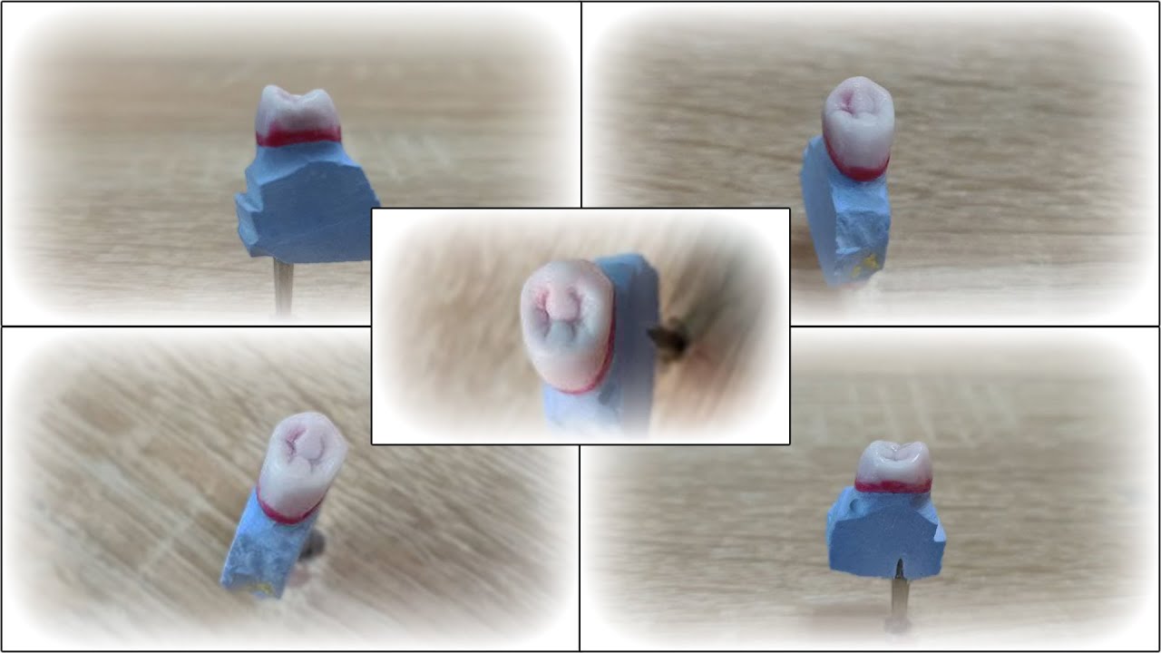 تشميع الضاحك العلوي الأول Waxup upper first premolar