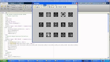 Brain Thmor Detection using Segmentation based Object Labeling Algorithm