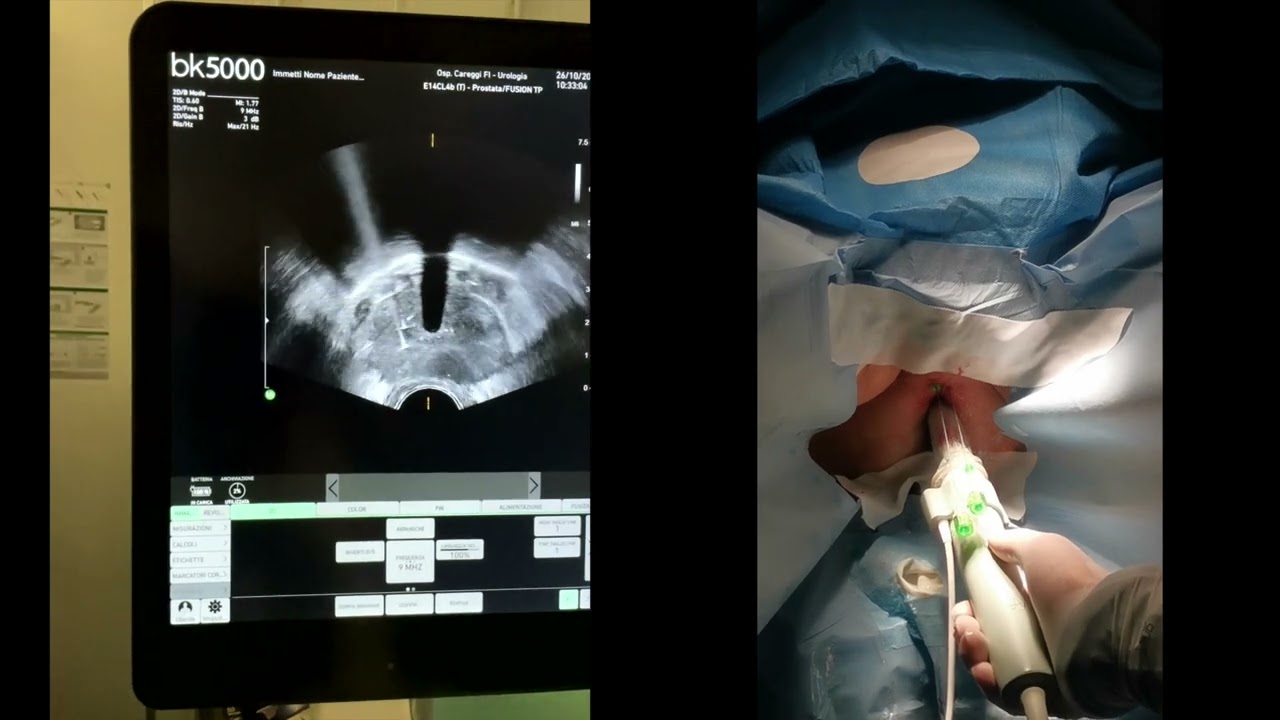 EchoLaser SoracteLite TPLA - IPB: a step-by-step guide. Careggi Hospital, Firenze.