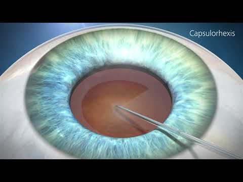 Cataract Surgery  Animation