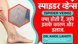 Everything You Need to Know About Spider Veins | Tips and Treatments