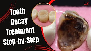 Restoration of a Massive Tooth Decay