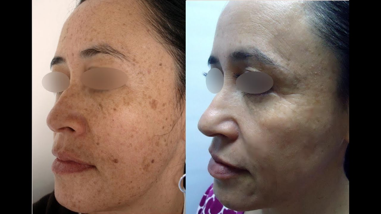 Tratamiento Laser para las manchas en la Cara, Manos, Axilas, Entrepierna  Tratamientos manchas Piel - YouTube