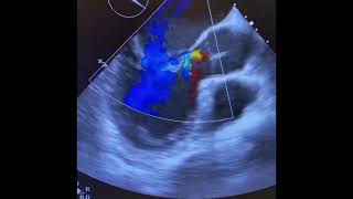 Mitral Qapaq Temiri Mitral Valve Repair Dr Natiq Mirzeyev Rdm