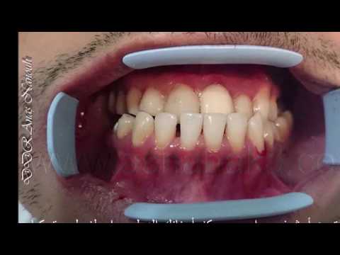 علاج اسنان العضة المعكوسة بدون جراحة أو تقويم خلال أسبوع