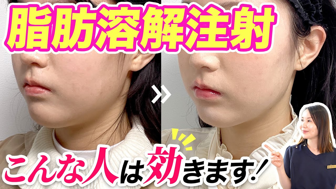 【症例紹介】脂肪溶解注射でバレずに顔＆二の腕の部分痩せ