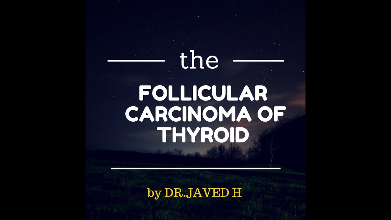Follicular carcinoma of Thyroid - YouTube