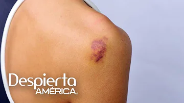 ¿Cómo curar un hematoma morado?