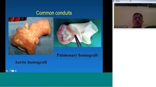 Surgical Management Of Pulmonary Atresia With Vsd Dr Ks Iyer