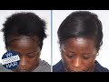 Hair Transplant for African American Women and Men