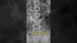 swallow safety pin.  foreign body in x ray #viral #shorts #short