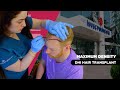 Maximum graft  dhi hair transplant