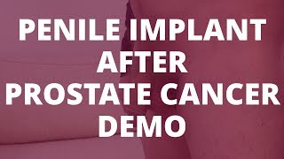 Penile Implant After Prostate Cancer | Demo (inflate/deflate)