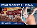 PENG BLOCK FOR HIP PAIN - NYSORA's Regional Anesthesia Clinical cases