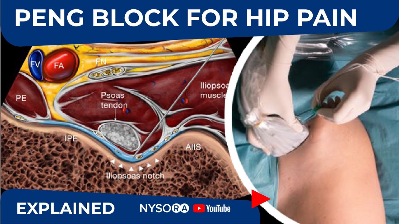 PENG BLOCK FOR HIP PAIN NYSORA s Regional Anesthesia Clinical Cases PENG BLOCK FOR HIP PAIN NYSORA s Regional Anesthesia Clinical Cases