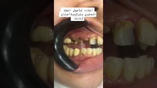 تغيير جذري لمريضة تعاني.. A radical change for a suffering patient dr_abdullah_sultan_dentist