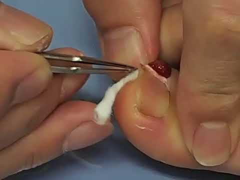 肉芽形成例 捻りコットン法 コットン充填固着法 Youtube 肉芽形成例 捻りコットン法 コットン充填固着法 Youtube
