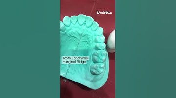 Landmarks on tooth surfaces |MARGINAL RIDGES | FULL VIDEO LINK IN DESCRIPTION | Short video