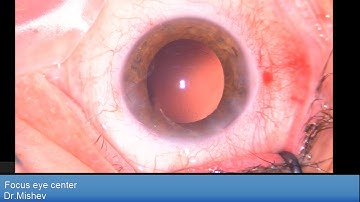 Oculentis LS313MF15 and Fuchs corneal dystrophy Lukan Mishev Live Stream