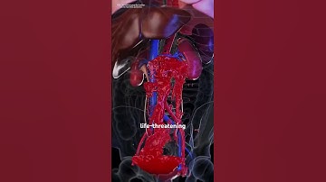 Endovascular Aneurysm Repair (EVAR).(3D animation) #music #motivation #epic #like
