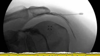 Inadvertent Deltoid Muscle Injection under Fluoroscopy - ThePainSource.com