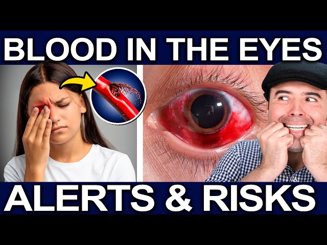 Blood in Your Eyes Is Not Normal! - What It Means and 5 Conditions That Can Cause Eye Bleeding