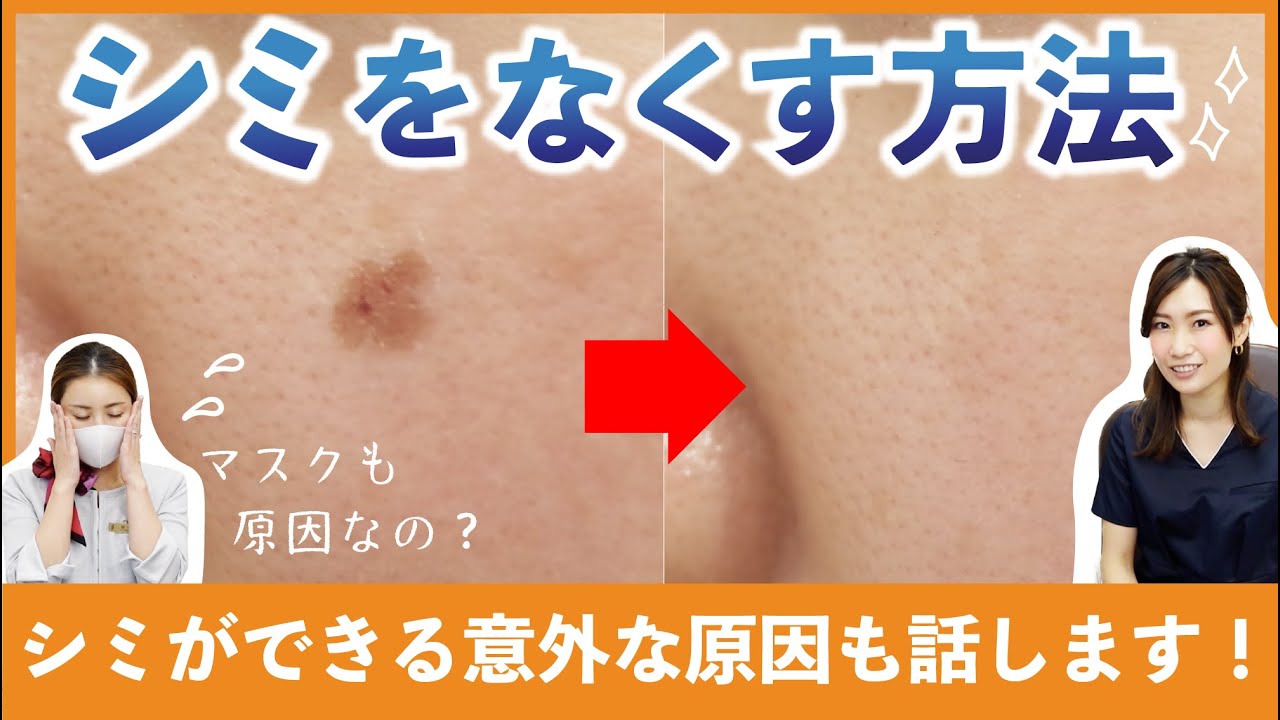 シミをなくす】シミ治療は何から始めるのが正解？（藤巻あいら