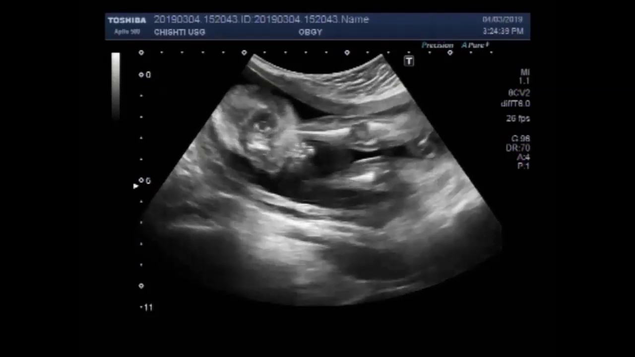 Ultrasound Video Showing Club Foot Fetal Anomaly Scan Youtube