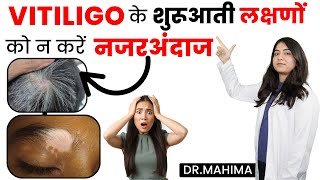 Early Sign & Symptoms Of Vitiligo in Hindi | सफेद दाग के शुरुआती लक्षण | Dr. Mahima
