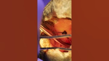 Removing a fishhook from a snapping turtles mouth #wildliferehab #turtlewatching