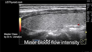 Thyroid Ultrasound. Minor blood flow intensity. // Master Class by Dr A. Ushakov