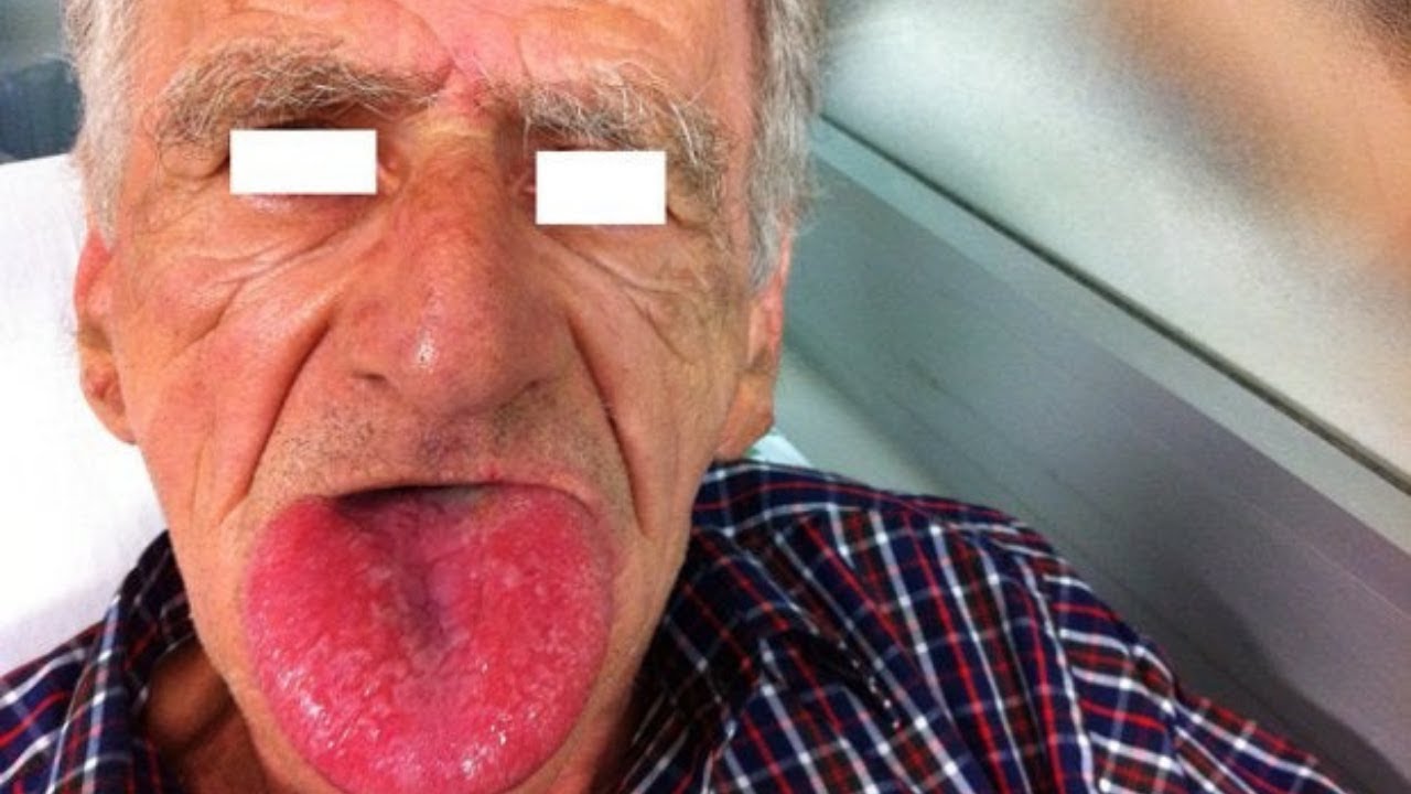 ANGIOEDEMA Causes Symptoms Treatment Diagnosis Hereditary ANGIOEDEMA Causes Symptoms Treatment Diagnosis Hereditary