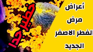 اعراض مرض الفطر الأصفر أخطر من الفطر الأسود و الفطر الابيض