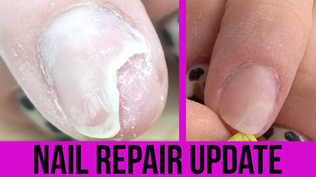 How To Fix A Broken Nail Diy Acrylic Nails At Home Youtube