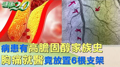 病患有高胆固醇家族史 胸痛就医竟放置6根支架 健康2.0 - 天天要闻