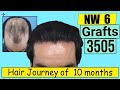 Hair Transplant Result in 10 Months,3505 Grafts,Grade 6@Eugenix by Expert Hair Restoration Surgeons