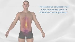 Medtronic - Osteocool animation
