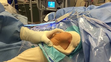 Patella Instability of the Knee and Treatment