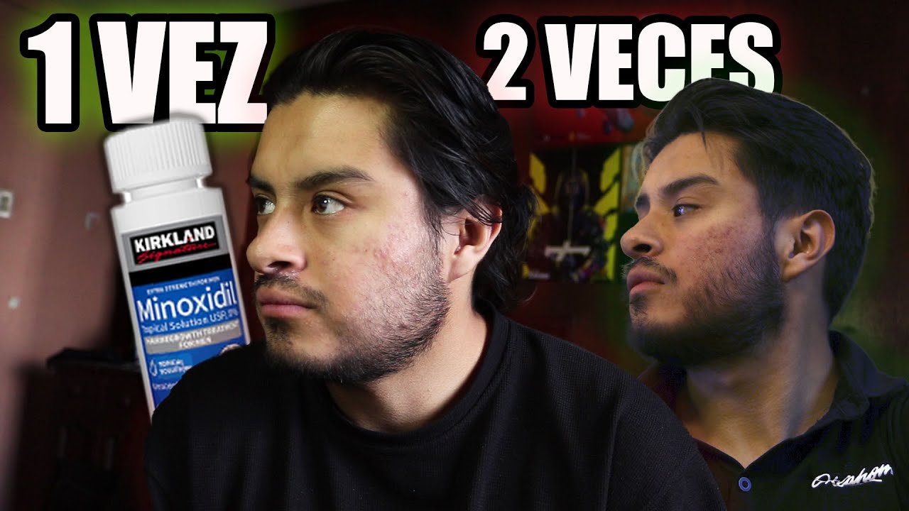 SEGURO ESTAS COMETIENDO ESTE ERROR AL APLICARTE MINOXIDIL PARA EL CRECIMIENTO DE BARBA!