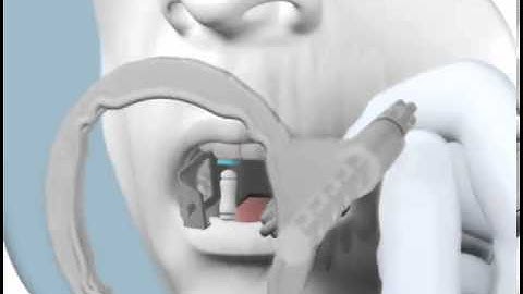 Endodontic Sensor Placement