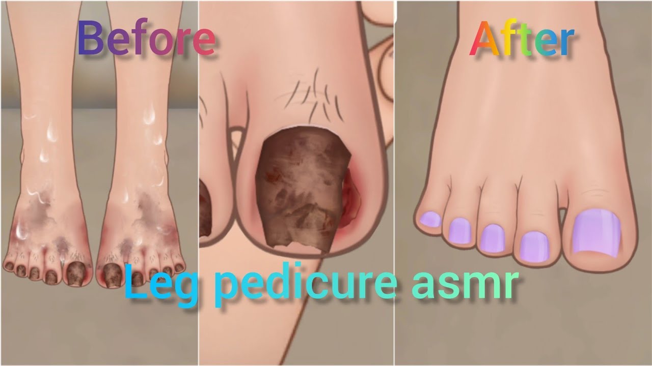 ASMR#leg pedicure asmr#toenail removal asmr animation#strong ...