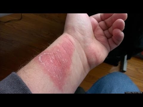 fitbit charge 3 burning skin