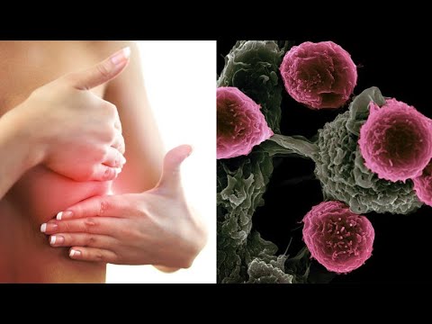 Video: La Nuova Immunoterapia Ha Risolto Tutti I Tumori In Una Donna Con Carcinoma Mammario Metastatico - Visualizzazione Alternativa