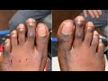 FOOT CORNS SURGERY TESTIMONIAL (BEFORE & AFTER VIDEO)