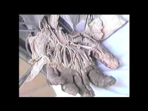 Video Giải phẫu Vùng Cẳng tay sau Bàn tay - GS Nguyễn Quang... - YouTube