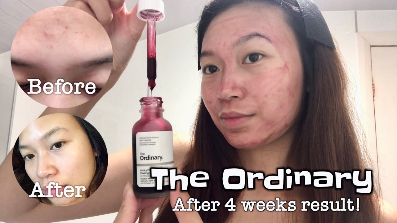 The Ordinary aha 30 + bha 2 peeling solution | After 4 weeks result # ...