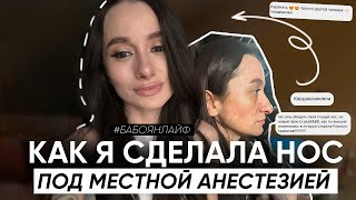 Я СДЕЛАЛА РИНОПЛАСТИКУ ПОД МЕСТНОЙ АНЕСТЕЗИЕЙ 😱 МОЯ ИСТОРИЯ И ВЫВОДЫ