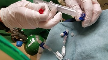 Connecting Prismaflex CRRT to the Cardiohelp ECMO circuit