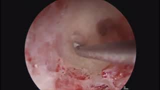 Endoscopic Repair of Superior Canal Dehiscence